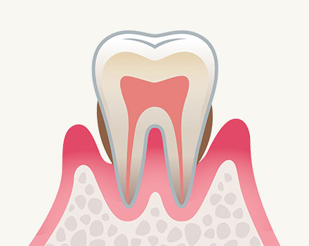歯周炎（中度）
