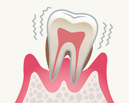 歯周炎（重度）